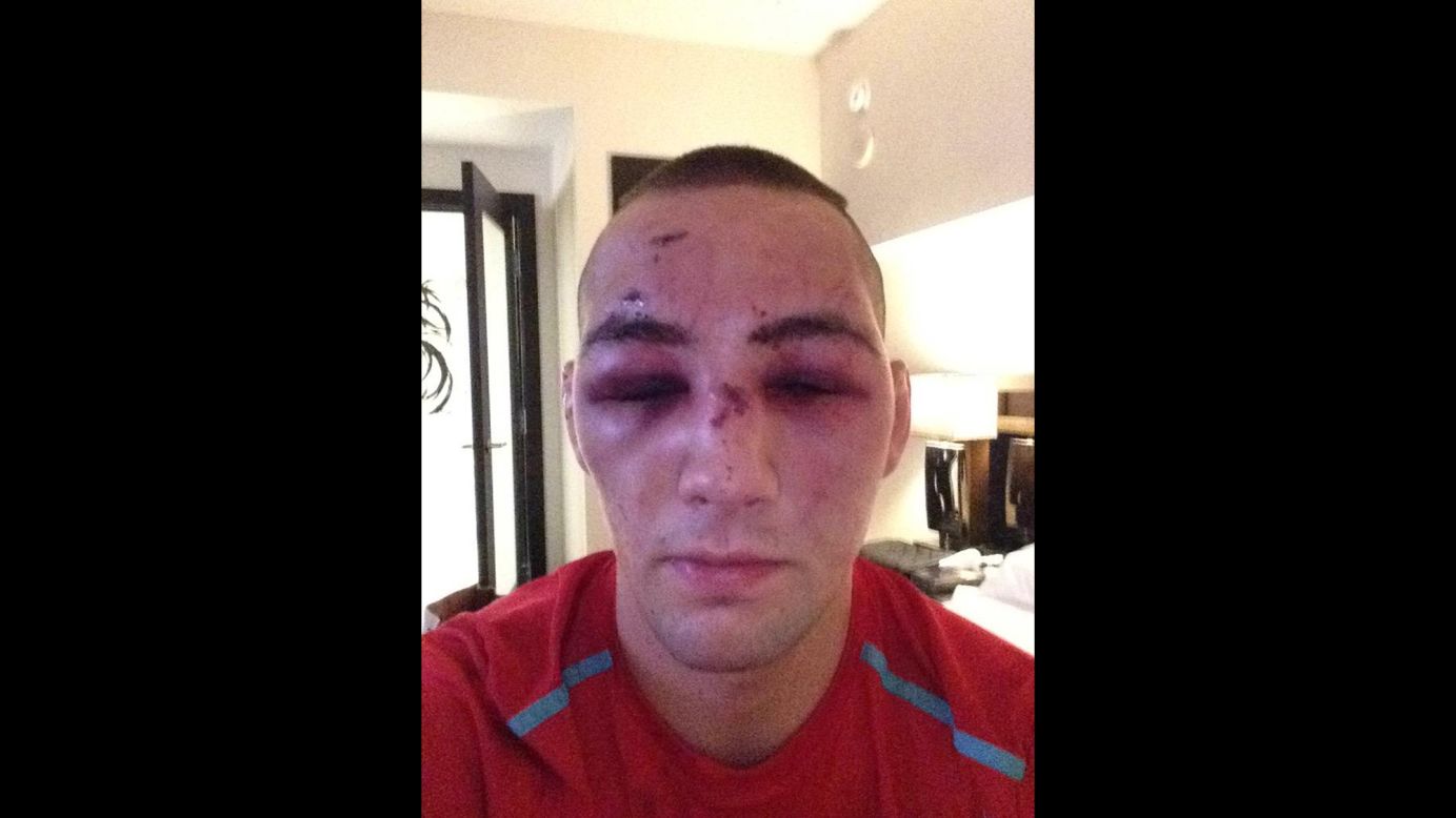 A bruised and battered Rory MacDonald <a href="https://twitter.com/rory_macdonald/status/620276950766981121" target="_blank" target="_blank">tweeted this selfie</a> on Sunday, July 12, a day after he lost a UFC title match on Saturday, July 11. "Broken nose broken foot but ill be back," he said.