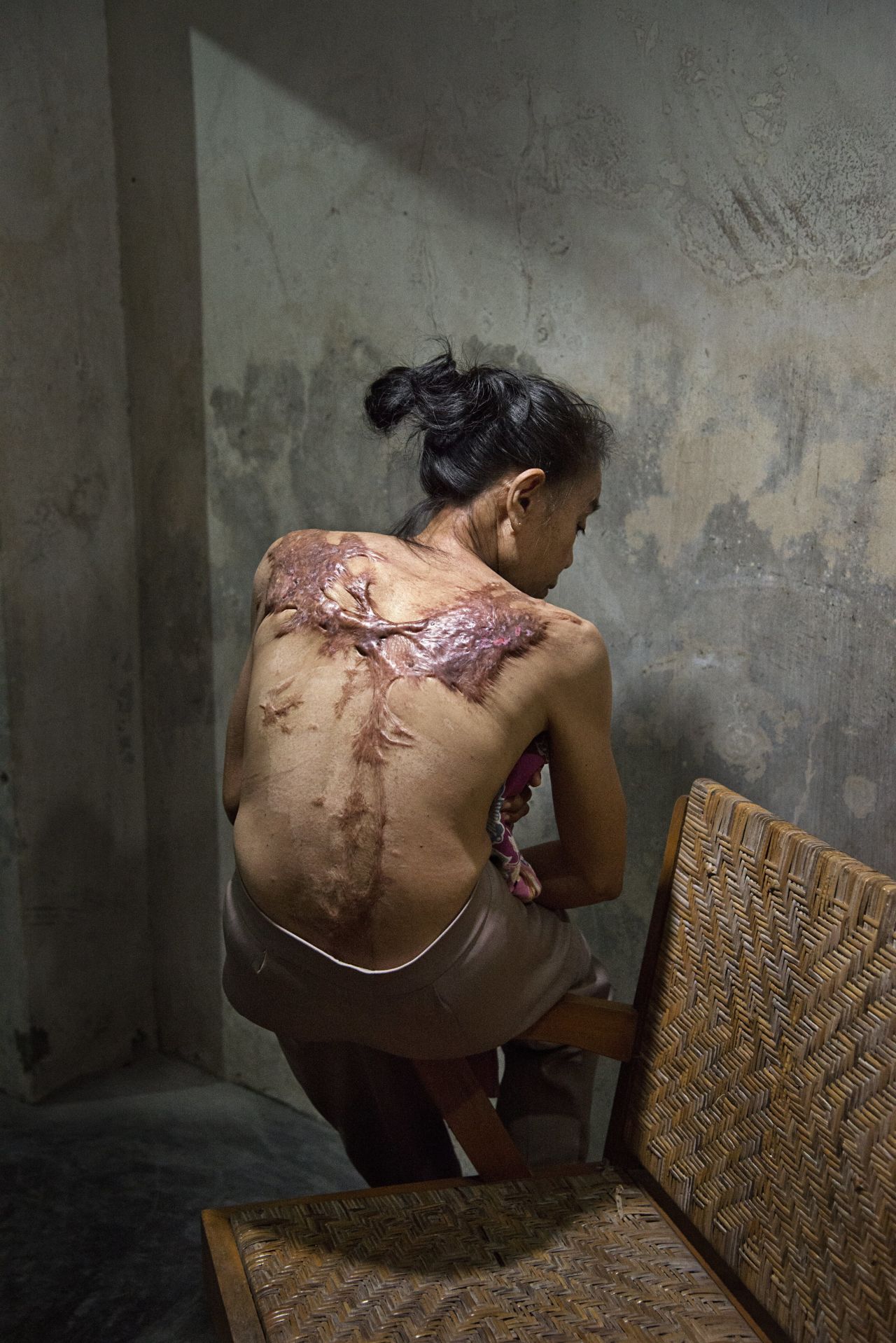 "I go to the clinic regularly to get medication. Now it is not painful any more. It was most painful the first four months." Sumasri's back and thighs are heavily scarred from the boiling water she said her male employer in Kuala Lumpur threw on her. The story of what exactly happened to her often changes when she recounts it.