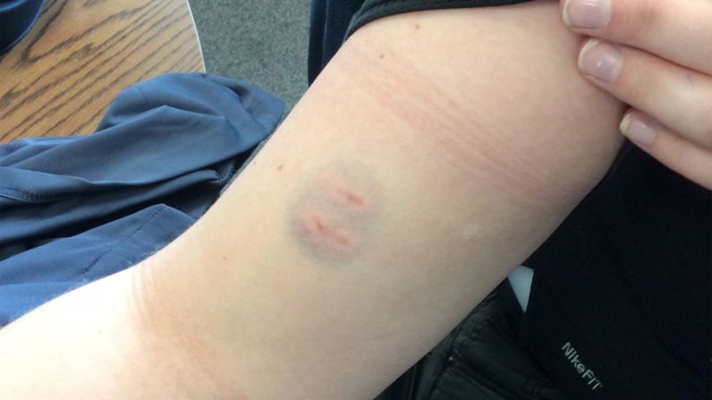 The students often physically attack their teachers and leave severe bite marks on their arms. 