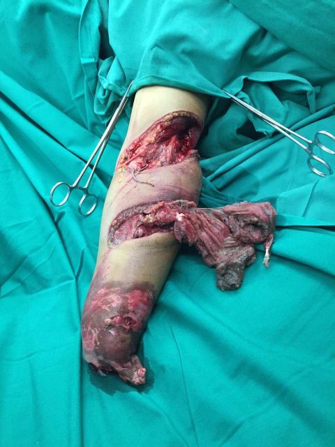 There are big risks to grafting a hand as in Zhou's case. The tissue in the hand and arm also had to be rebuilt and this procedure could fail.