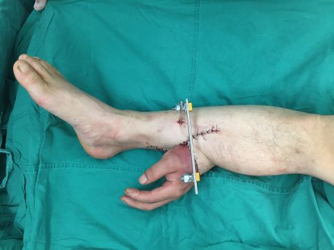A man in China, identified as Mr. Zhou, lost his left hand in an industrial accident. It was grafted to his lower calf and connected to blood vessels in the region to keep the tissue alive. 