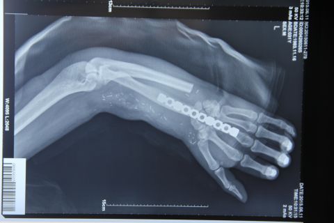 An X-ray of Zhou's left arm after his hand was reattached.