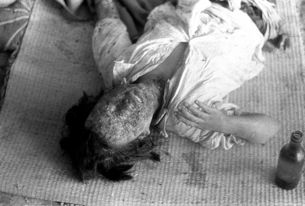 A patient suffering severe radiation burns lies in the Hiroshima Red Cross hospital in August 1945. Many of those who survived the initial blast on August 6 died of severe radiation-related injuries and illnesses. 