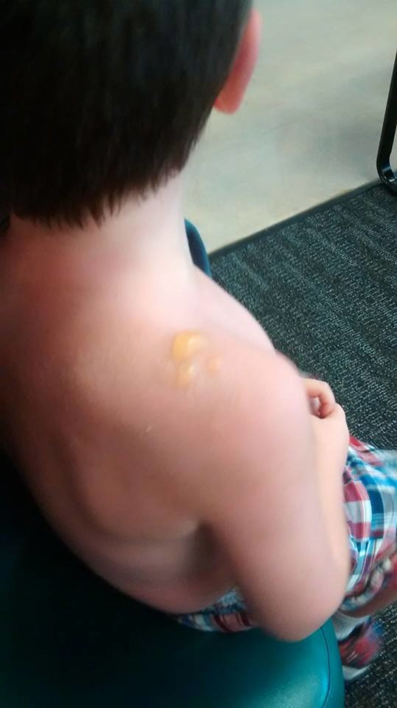 Trae Broadway suffered from second degree burns, resulting in small blisters on his shoulders and back. 