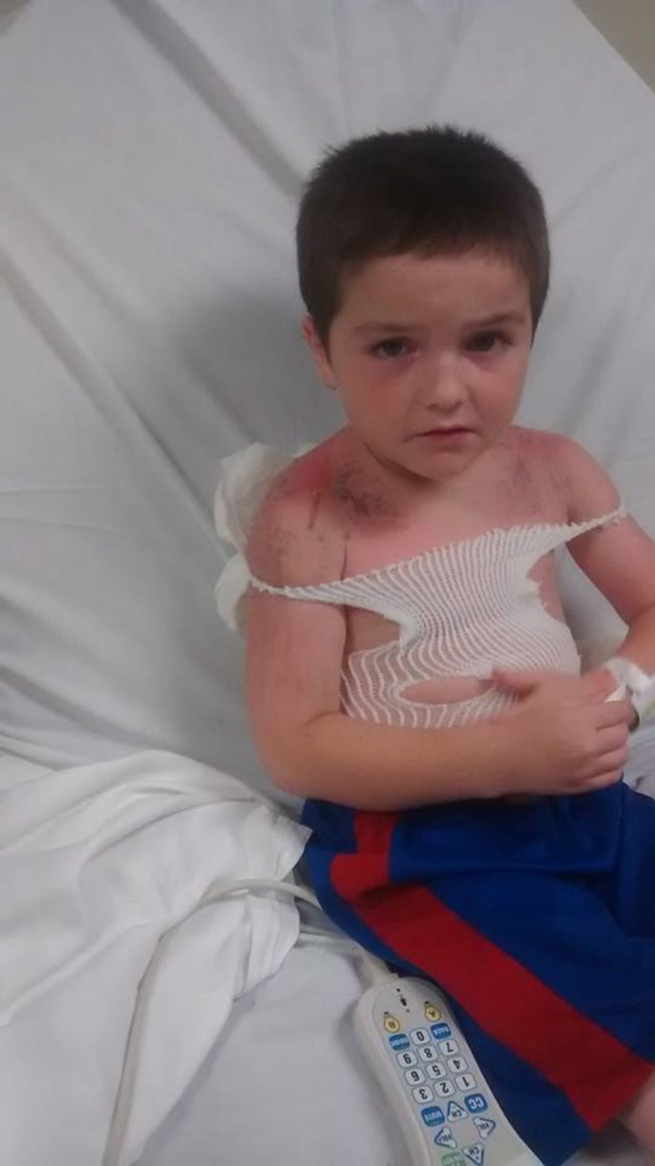 Trae, age 5, suffered second degree burns. 