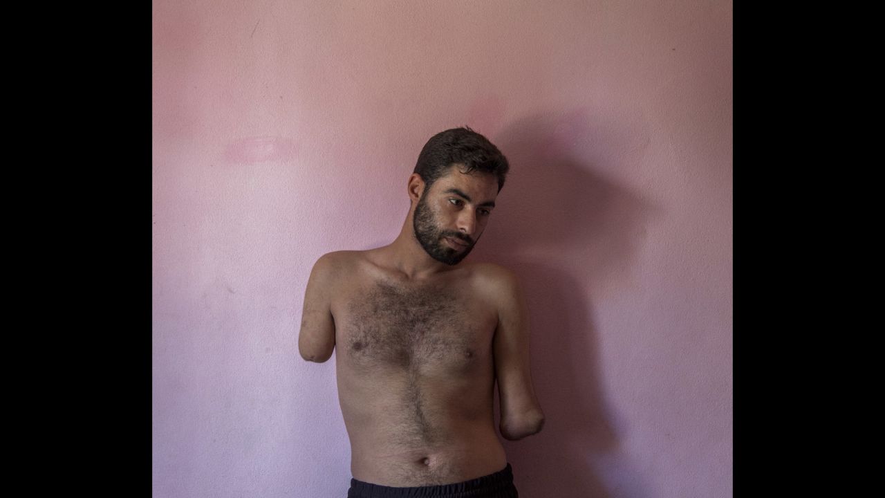 Mohammed, 22, was injured in March 2013 when his family home in Qusayr, Syria, was hit by government shelling. His uncle was killed, and many of his family members were injured in the same incident. He now lives as a refugee with his wife and young child in Tripoli, Lebanon.