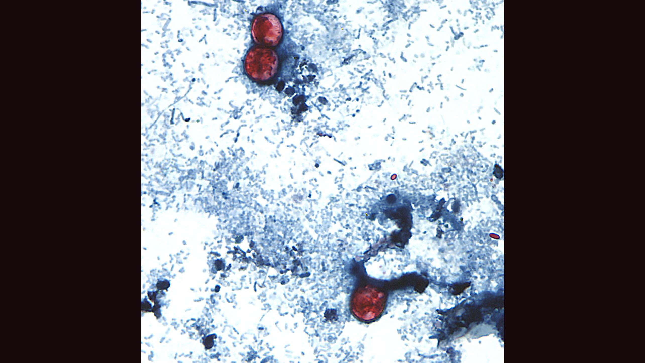 Parasitic cyclospora infections up 134% this summer | CNN