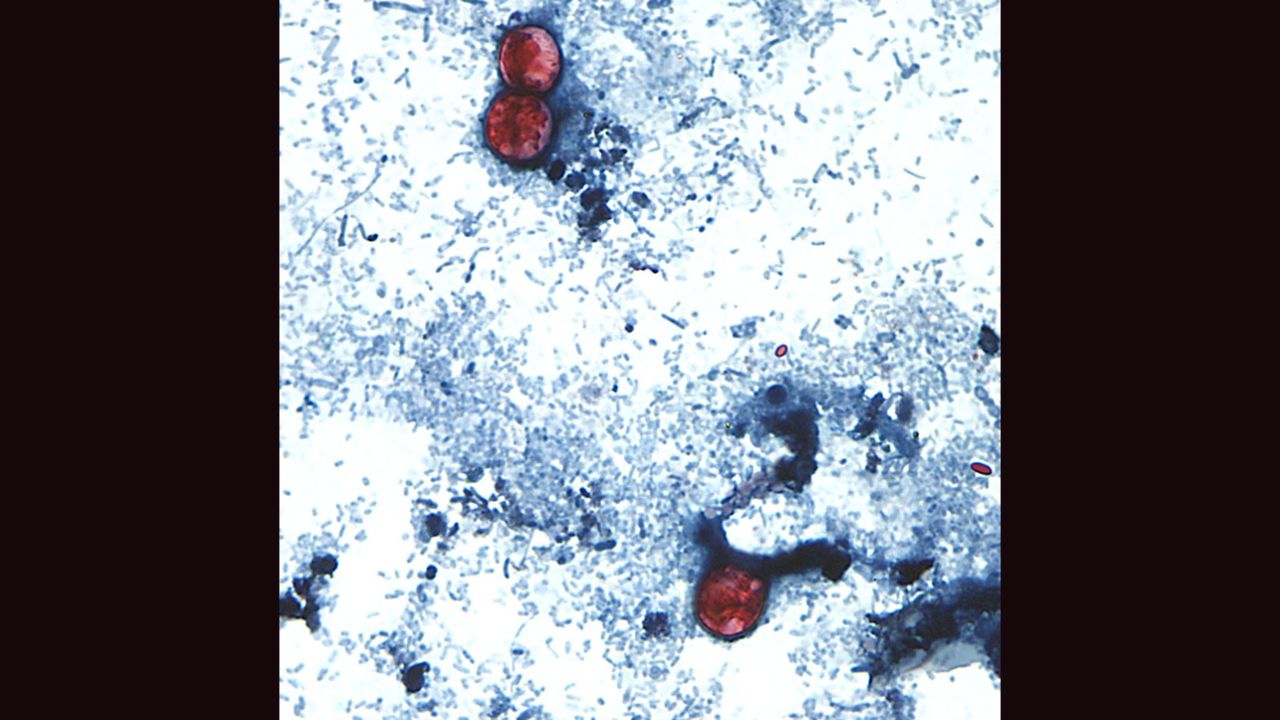 <strong>Cyclosporiasis:</strong> An intestinal infection caused by the cyclospora cayetanensis parasite, seen here on a stool sample through a microscope on a slide. Cyclospora infect the small intestine and most commonly cause watery diarrhea; other symptoms include abdominal cramping, nausea and weight loss. 