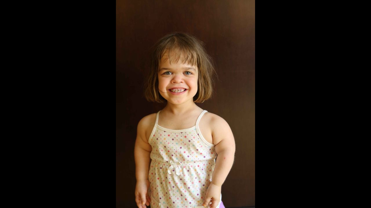 Irina, in her own words: "I was born in Russia. I was put in an orphanage when I was 4 days old. My mom and dad adopted me when I was five, now I live in Maine. I have two younger sisters. I have achondroplasia, which is the most common form of dwarfism. My bones just don't grow as fast as the average kids, so I'm short. I like Spider-Man, Batman, pirates and trucks. I like to ride my bike and play basketball."