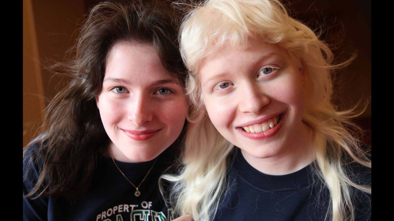 Arielle and Sarah are twins. Arielle has albinism.