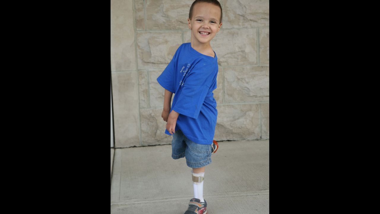 PJ, living with arthrogryposis multiplex congenita, has trouble using his arms. But that doesn't keep him from teasing his brother. The disease results in decreased flexibility of joints.