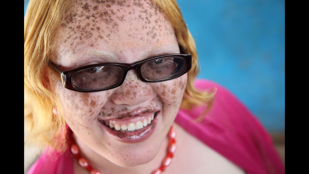 Jayne Waithera, also featured in "On Beauty" has albinism.  She has worked with Guidotti to create Positive Exposure Kenya, raising awareness and reducing the stigma associated with albinism. Waithera, recipient of the 2015 Nelson Mandela Washington Fellowship, recently met with U.S. President Barack Obama through the Young African Leaders Initiative. 