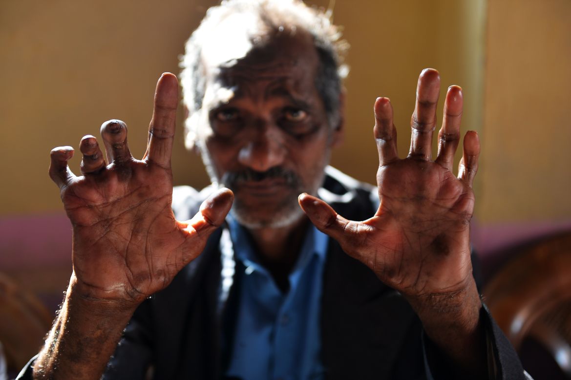 There were 216,000 global cases of leprosy, an ancient and disfiguring disease, in 2013. 