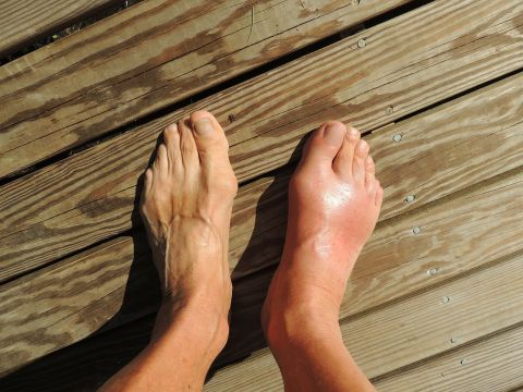 Gout was once known as the "disease of kings" because of its links to excessive food and alcohol consumption. These days, unhealthy lifestyles are behind an increase in gout in developed countries.