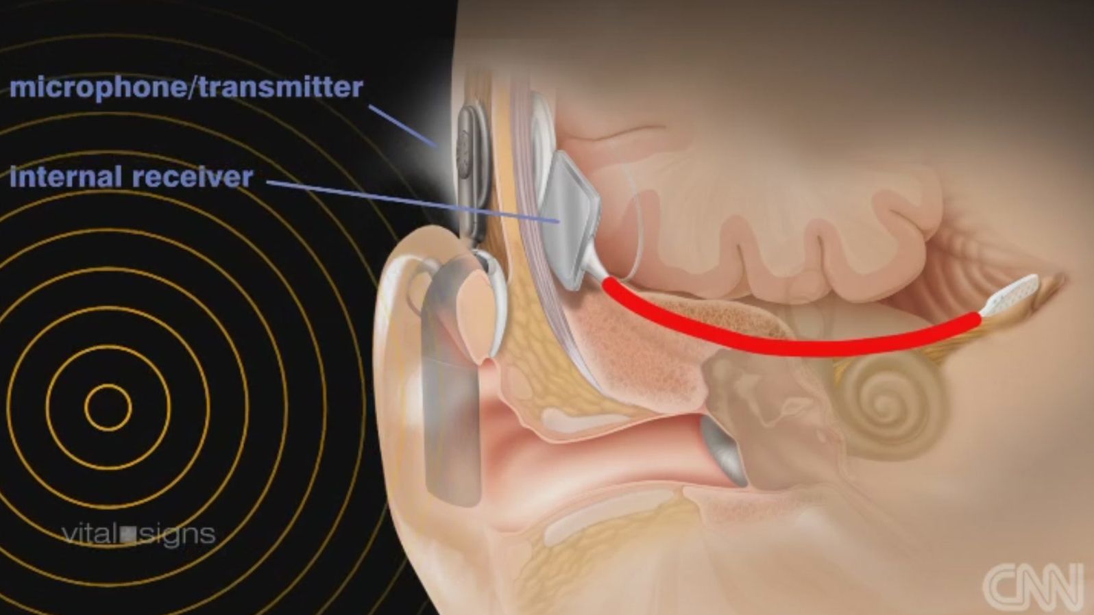 auditory brain implant graphic