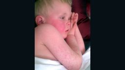 Characteristic red cheeks and rash of scarlet fever