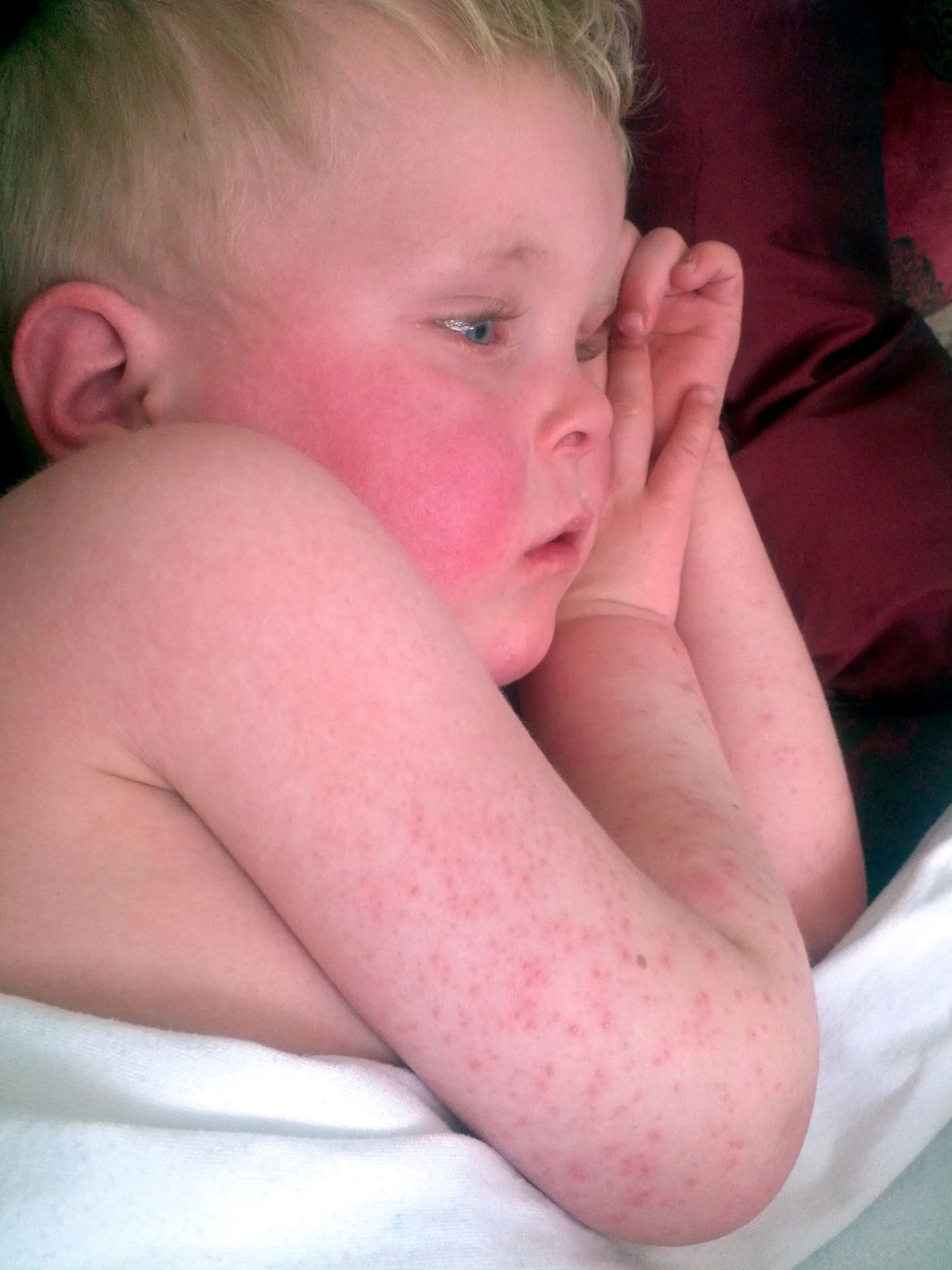 scarlet fever bacteria