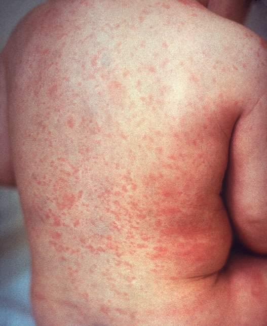 Rise in scarlet fever cases shows 49-year high, health experts say - BBC  News
