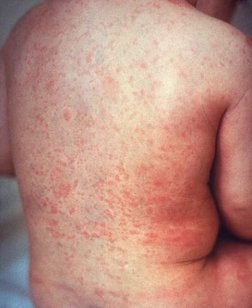 Scarlet Fever Makes A Dangerous Comeback