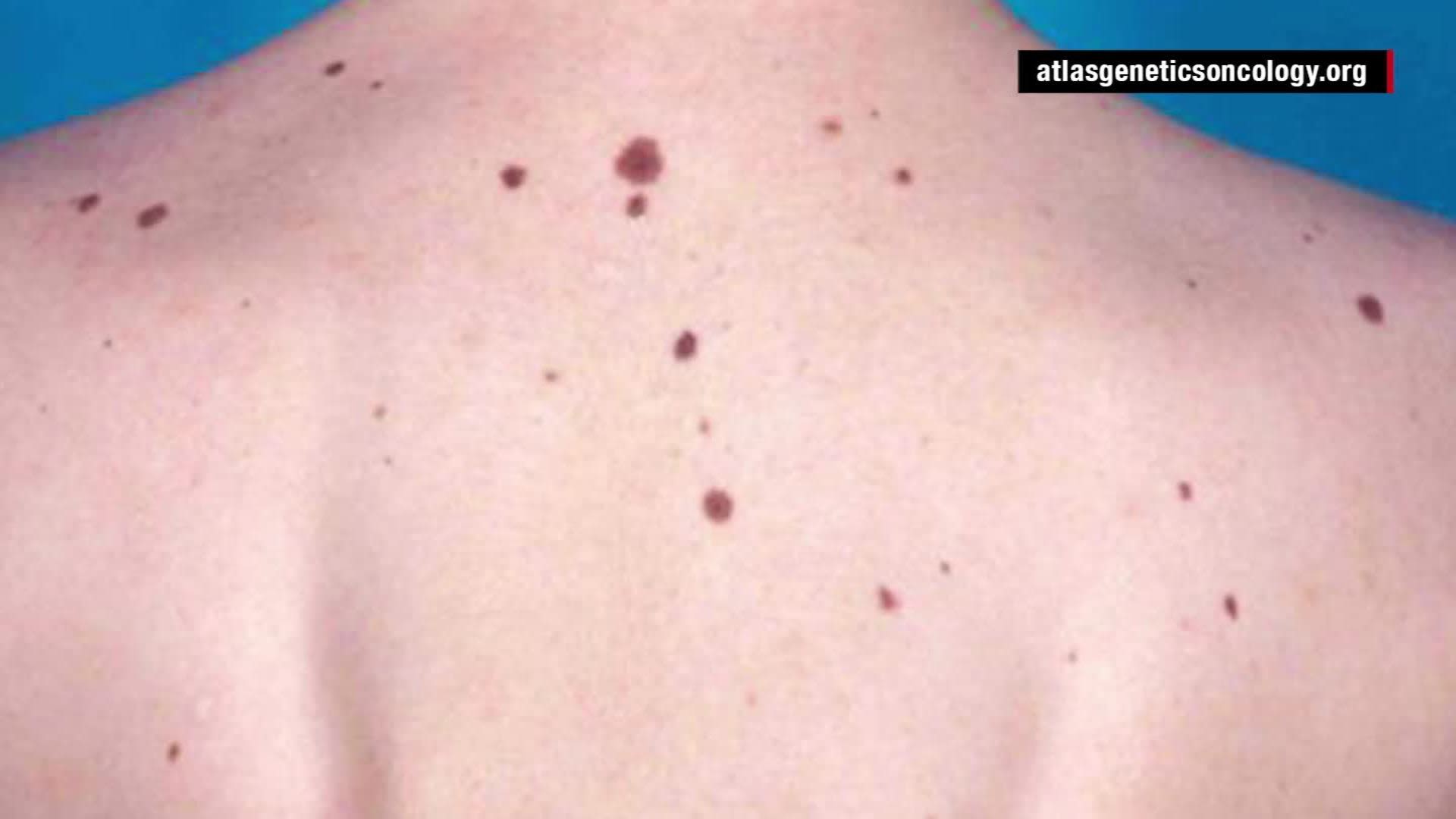 A Case of Skin Cancer, Science Take-Out