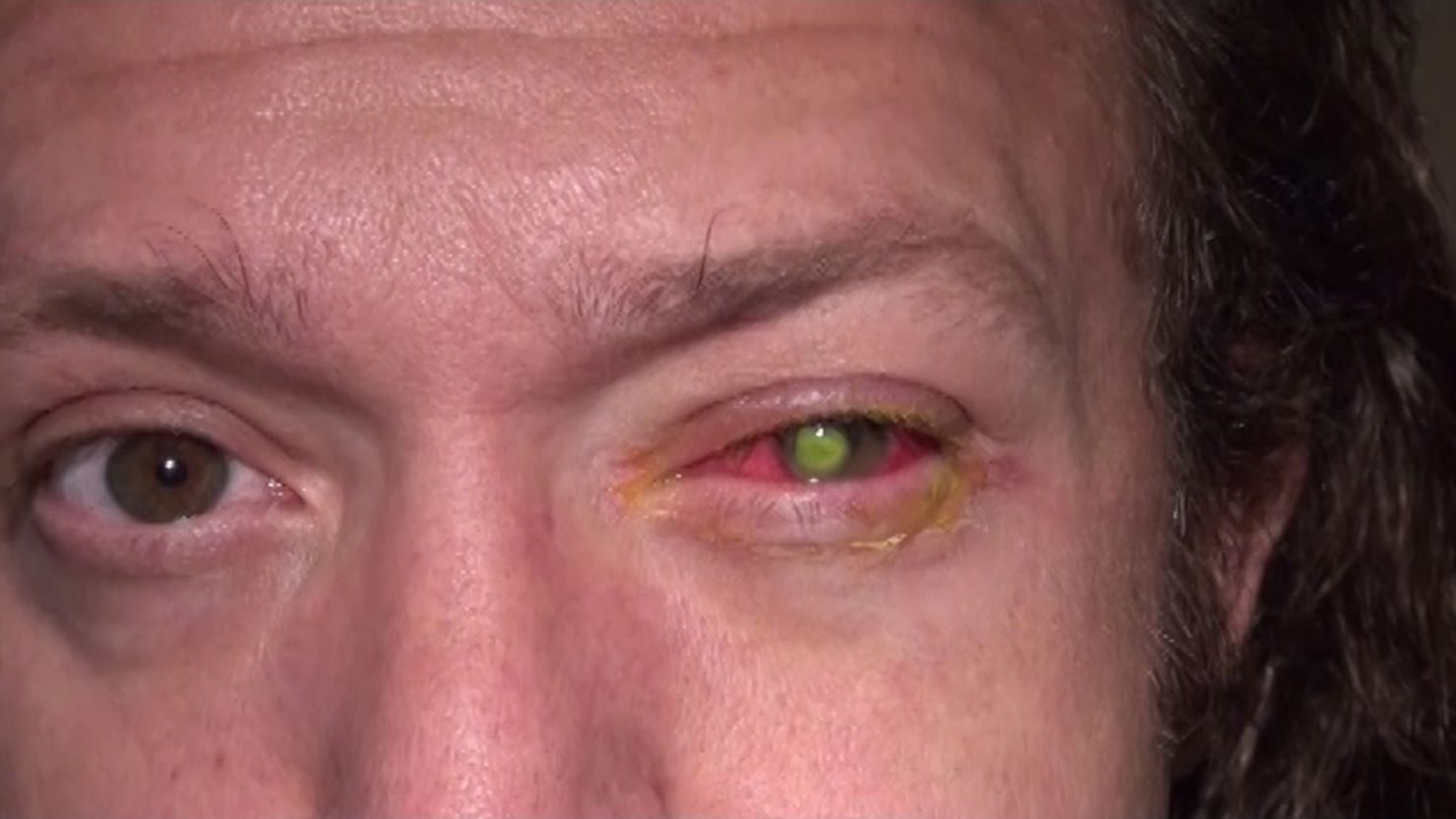 Chad Groeschen developed a dangerous bacterial infection in his left eye after sleeping in contact lenses. 