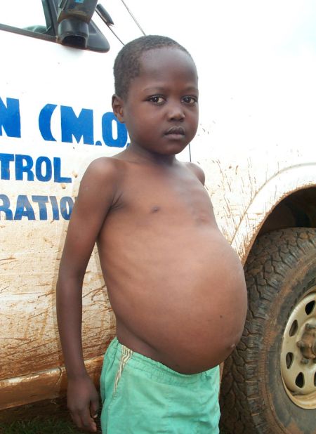 The characteristic symptom of Schistosomiasis is a distended stomach -- swollen abdomen -- caused by inflammation resulting from parasitic eggs trapped in the intestinal lining as they migrate out of the body.