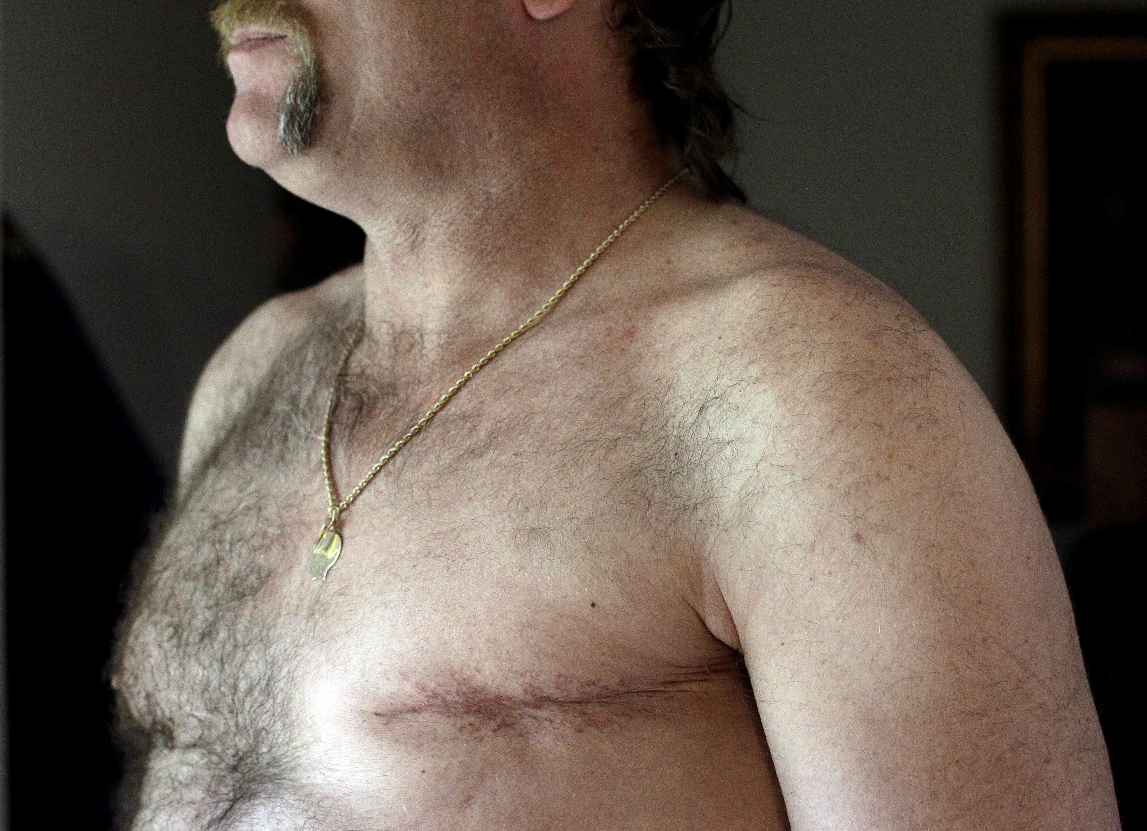 Double mastectomies for men with breast cancer on the rise