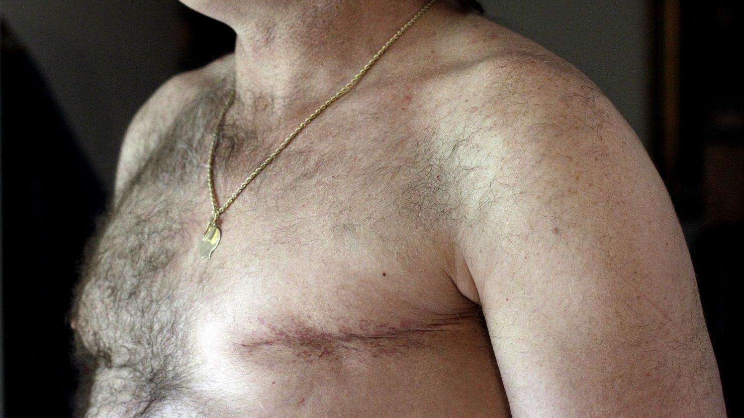 Double mastectomies for men with breast cancer on the rise