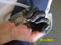 Paul Gaylord's hand as it developed gangrene. 