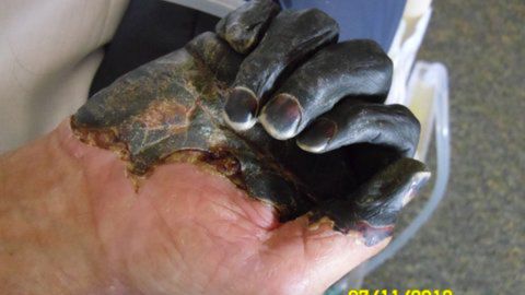 Paul Gaylord's hand as it developed gangrene.