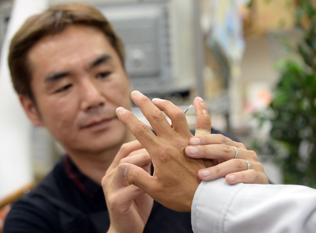 Prosthetics specialist Shintaro Hayashi, left, inspects the silicone finger of a former yakuza member in Tokyo.