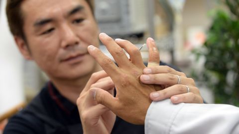 Prosthetics specialist Shintaro Hayashi, left, inspects the silicone finger of a former yakuza member in Tokyo.