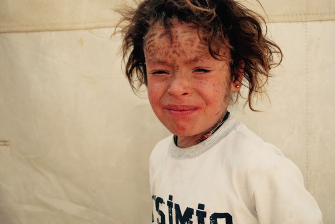 Marwa Khalil, who is eight years old, escaped from Sinjar with her family. She suffers from a skin disease and can't go to school because other children refuse to sit next to her. <br />