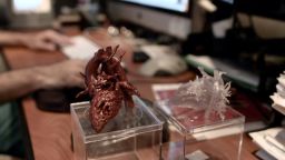 Mia's surgeon carried around a model of the girl's heart for weeks.