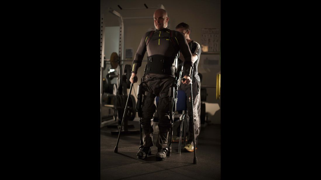 Pollock has taken thousands of steps with robotic legs under the guidance of doctors at UCLA.