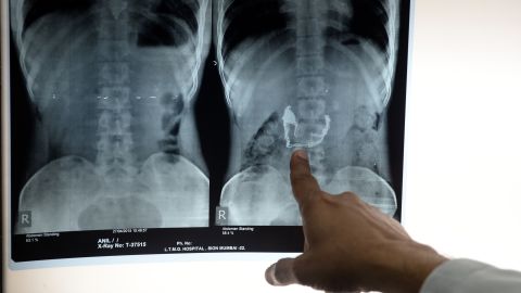 Discovered accidentally by German physicist Wilhelm Conrad Röntgen, X-rays allowed doctors to see inside the human body for the first time without the use of surgery. They were used during the Balkan War to locate bullets and broken bones in patients. While doctors and scientists were eager to use X-ray technology, they didn't understand how strong the effects of radiation could be. In 1904, Thomas Edison's assistant, who worked with X-rays daily, died of skin cancer. Today, the technology is widely used. 