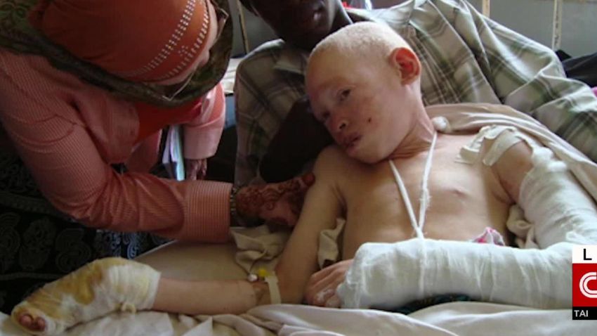 tanzania albino teen los angeles bones sidner dnt nr_00004106.jpg