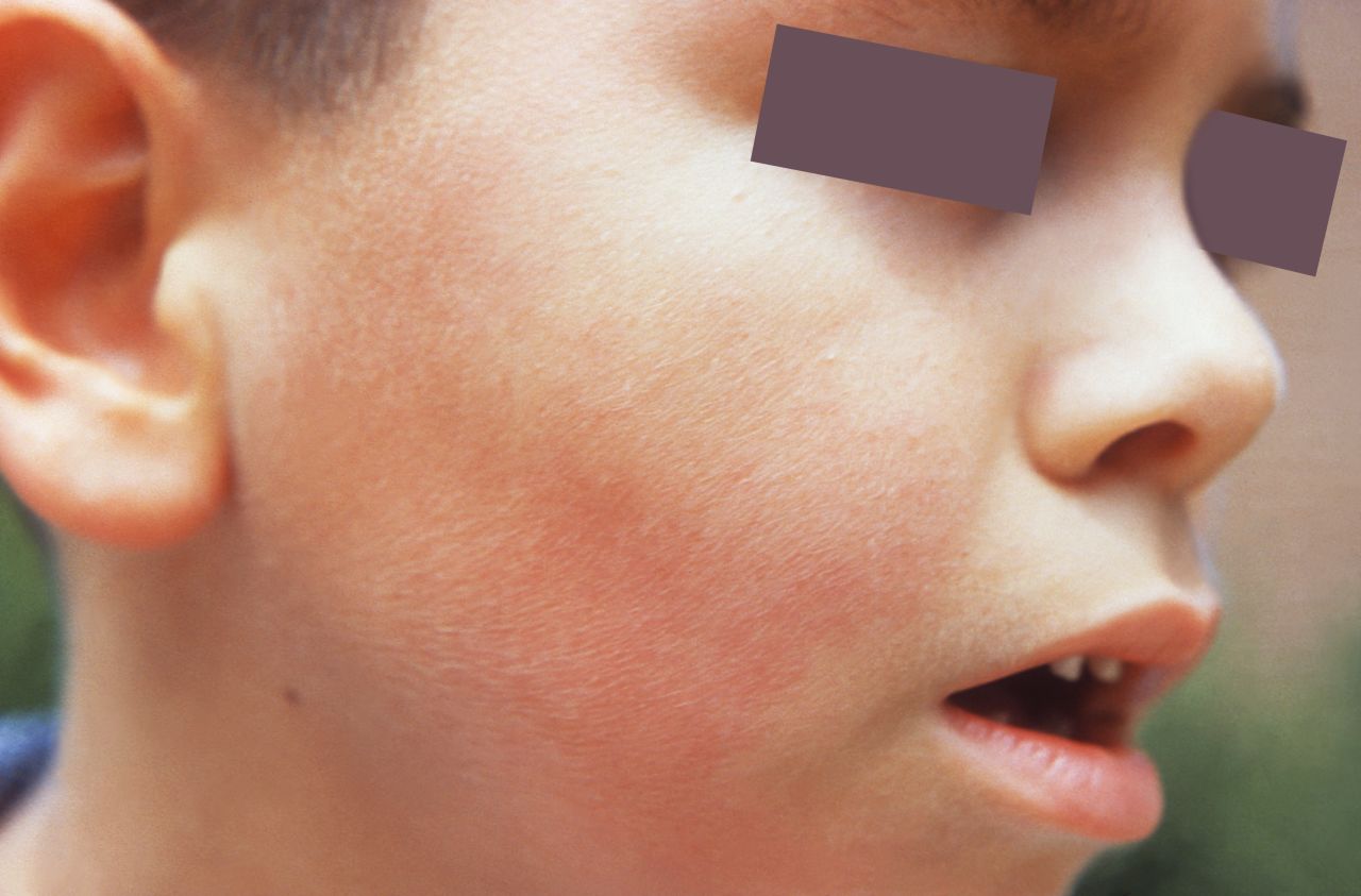 Fifth disease is a mild rash caused by parvovirus B19, <a href="http://www.cdc.gov/parvovirusb19/fifth-disease.html" target="_blank" target="_blank">according to the CDC</a>. It's sometimes called "slapped cheek" disease because of a red rash on the face. It's often spread by coughing and sneezing. It's most contagious before the rash appears, when its symptoms are similar to a cold.