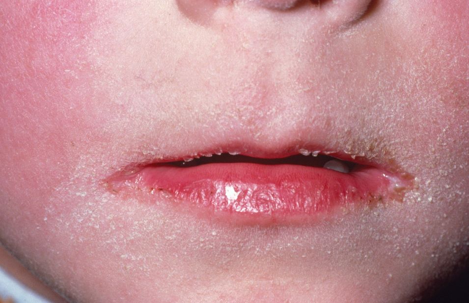 Scarlet fever is a bacterial infection caused by group A Streptococcus. A common symptom is a rough, red rash, <a href="http://www.cdc.gov/Features/ScarletFever/" target="_blank" target="_blank">according to the CDC</a>. It's usually a mild illness and treatable with antibiotics. It usually affects children between 5 and 12, although anyone can get it.<br />