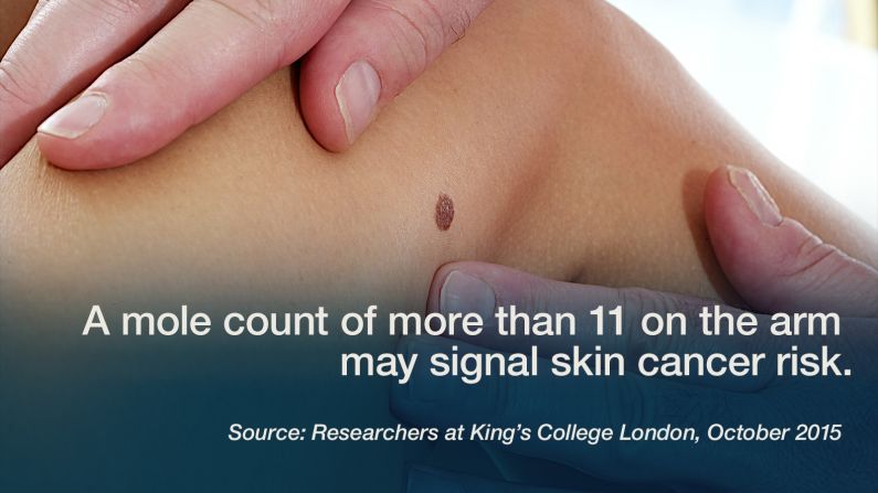 The number of moles on a person's body can be an important marker for risk of skin cancer, but counting them all can be tough and time consuming. <a href="http://onlinelibrary.wiley.com/doi/10.1111/bjd.14216/abstract" target="_blank" target="_blank">Researchers at King's College London found</a> that tallying the number on a smaller "proxy" area of the body -- especially the right arm - can make it easier to estimate the total number of moles and identify those most at risk. Researchers reviewed information on 3,694 white female twins who were part of the TwinsUK study. The researchers said, "We demonstrated that arm naevus count of more than 11 is associated with a significant risk of having more than 100 naevi, that is in itself a strong predictor of risk for melanoma." -- Lauren Sennet