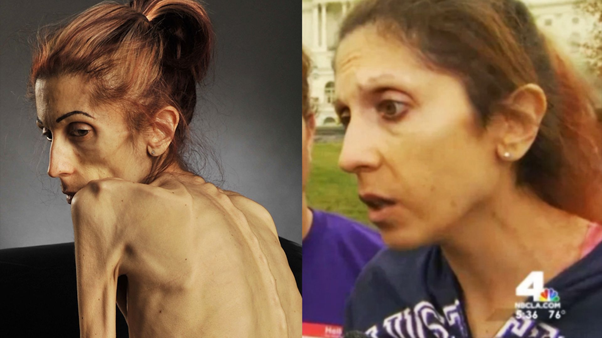 40 Age Girl Xxx Video - Rachael Farrokh winning battle against anorexia | CNN