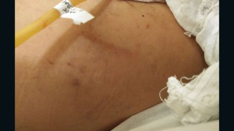 Some of Huang Tanghong's bruises and injuries are pictured.