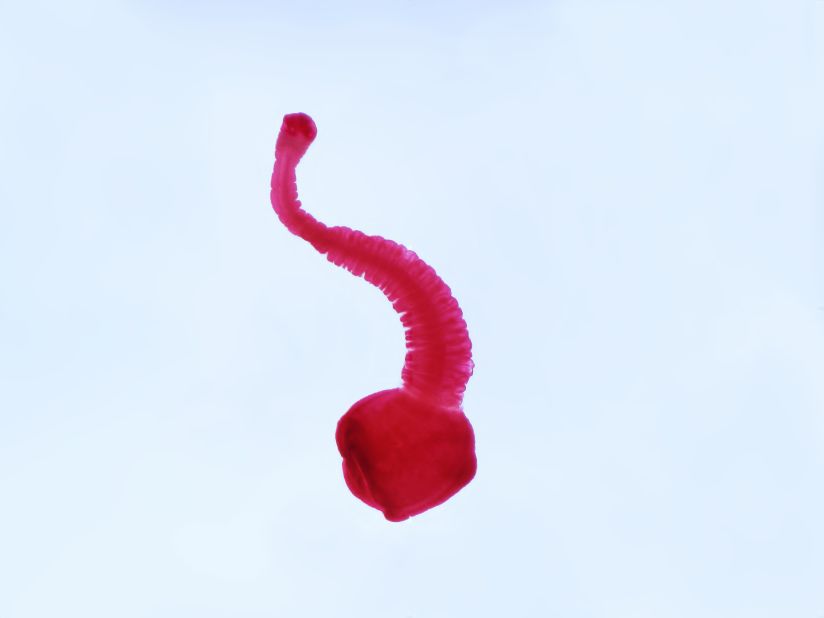 <strong>Tapeworm, aka Neurocysticercosis, aka T. solium:</strong> This is Taenia solium, the pork tapeworm that causes one of the grossest diseases we're heard about in a while. It's responsible for the worst headache of Luis Ortiz's life. When surgeons looked in his brain, they found a "wiggling" tapeworm inside a cyst. That's called neurocysticercosis, and the Centers for Disease Control and Prevention says that about 1,000 people a year get them from eating something infected with "microscopic eggs passed in the feces of a person who has an intestinal pork tapeworm."  