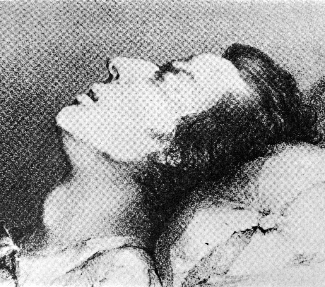 A drawing of composer Frederic Chopin dying from tuberculosis, 1849.