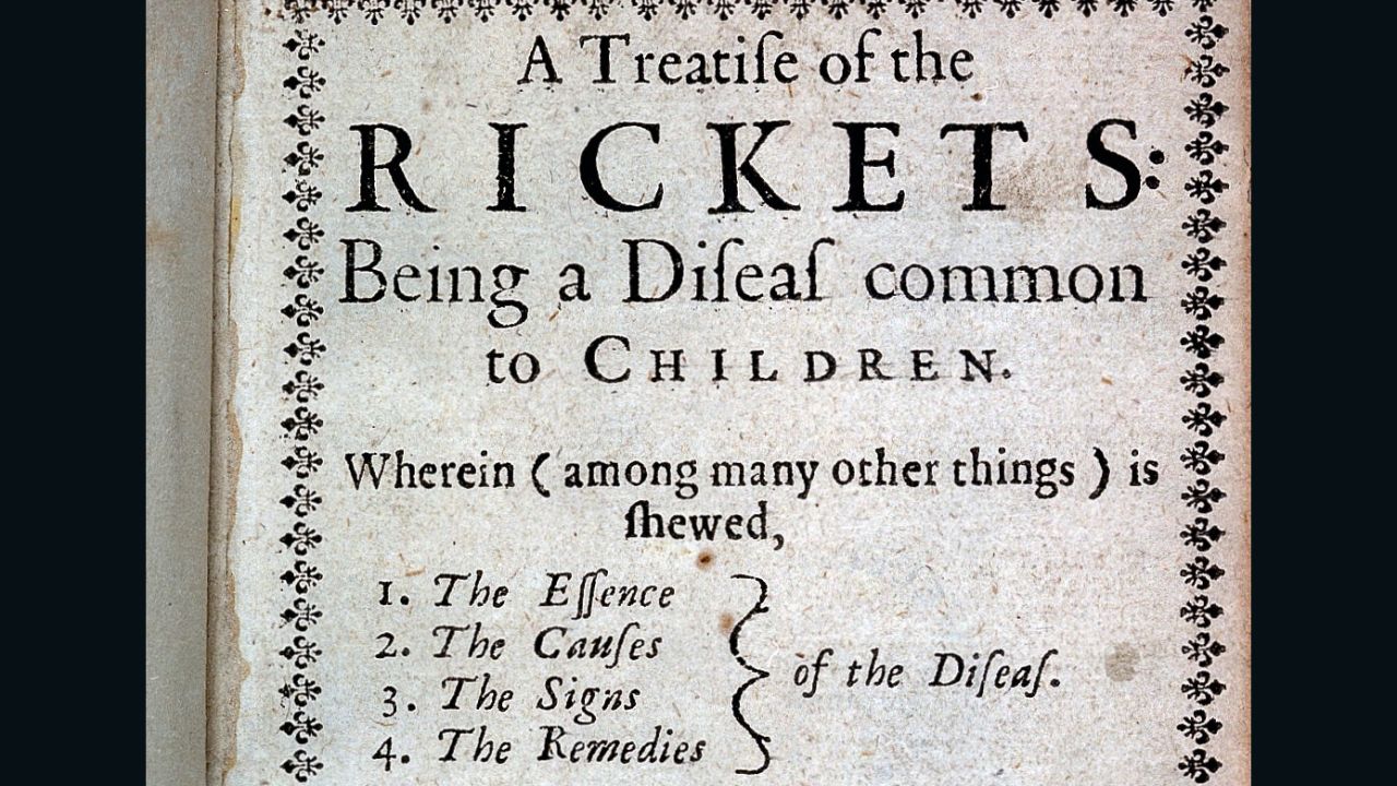 "A treatise of the Rickets," published 1651.
