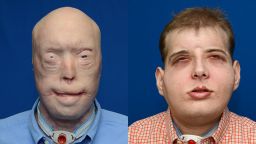 Patrick Hardison, 41, had face transplant surgery in August 2015. The surgery was performed by a plastic surgeon from New York University Langone Medical Center. Hardison, a volunteer firefighter, was injured 15 years ago.