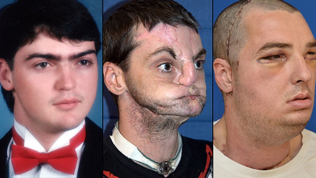 American Richard Norris: left, in high school in 1993; center, after suffering a gunshot injury; right, after face transplant surgery. 