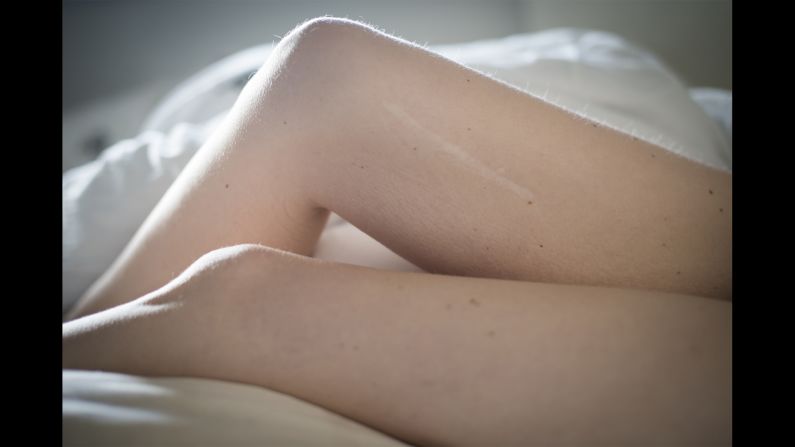 Camilla's legs. On her right thigh, she has a big scar from the biopsy a doctor did when she was 3 years old. By examining this sample, doctors can distinguish different forms of muscular dystrophy. 