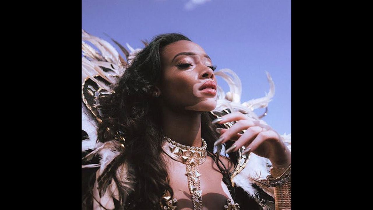 She now chooses to go by Winnie Harlow -- a name created for her confident alter ego. 