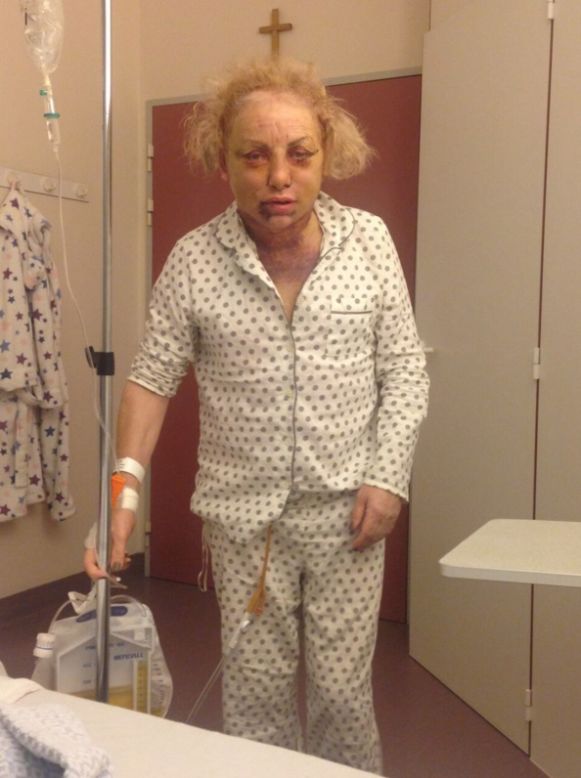 Maloney has spent over $150,000 on operations to feminize her appearance. After having facial surgery in Belgium, she was left in intensive care due to excessive swelling.  